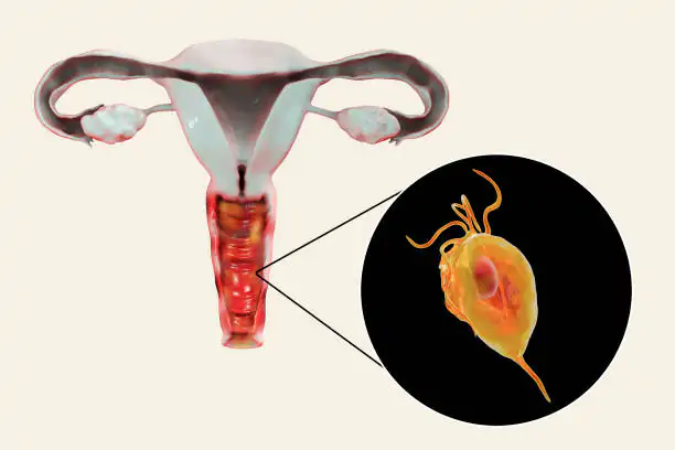 Trichomoniasis